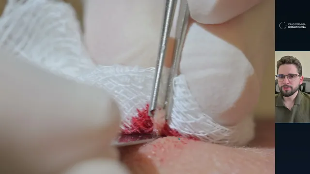 Biópsia por punch na região frontal: profundidade, segurança e diagnóstico vascular