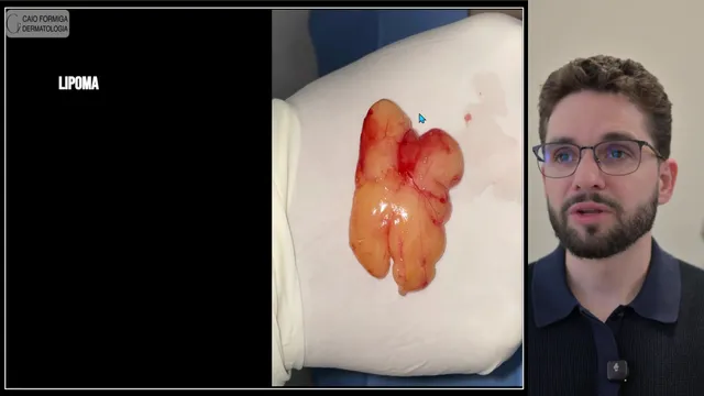 Lipoma