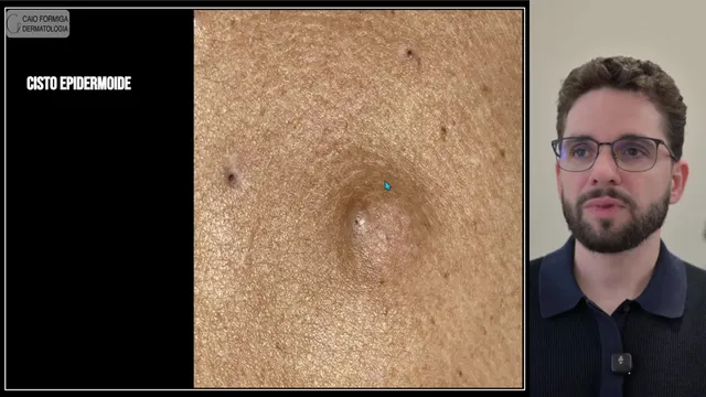 Cisto epidermoide