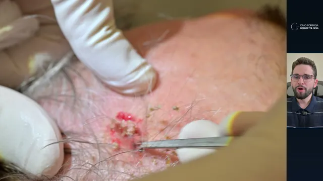 Ceratose seborreica: curetagem superficial, profundidade ideal e segurança diagnóstica