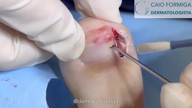 Cirurgia para unha encravada (onicocriptose)