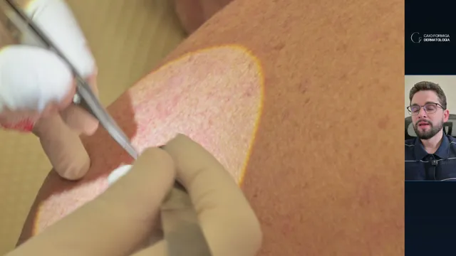 Carcinoma basocelular bem delimitado: excisão fusiforme com margem e plano seguro
