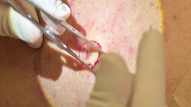 Carcinoma basocelular: biópsia excisional