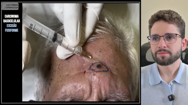 Carcinoma basocelular: excisão fusiforme