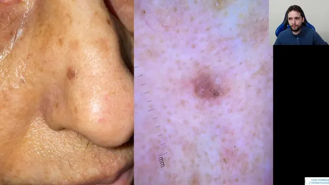 Carcinoma basocelular