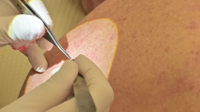 Carcinoma basocelular: biópsia excisional 