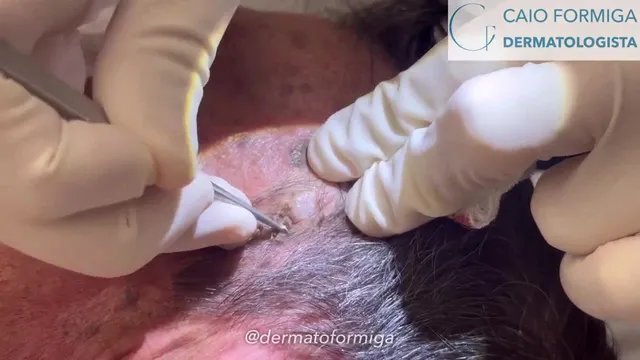 Ceratose seborreica: curetagem