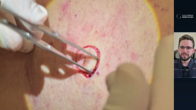 Carcinoma basocelular ulcerado: excisão fusiforme e dissecção no subcutâneo