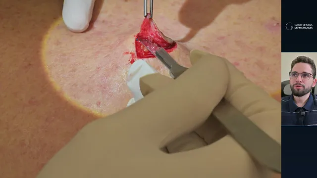 Carcinoma basocelular: excisão fusiforme, margens e plano de dissecção