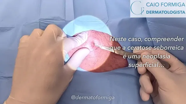 Ceratose seborreica inflamada: excisão tangencial