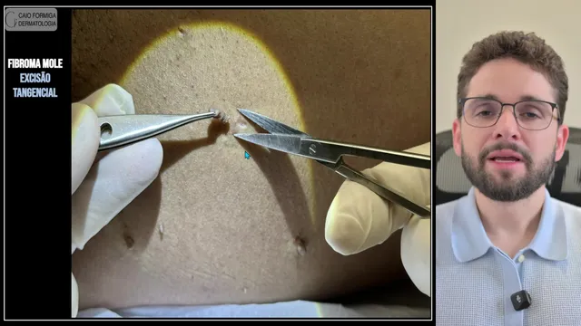 Fibroma mole: excisão tangencial