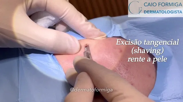 Verruga viral HPV: excisão tangencial