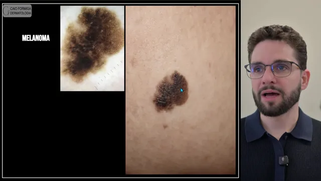 Melanoma