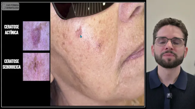 Ceratose actínica