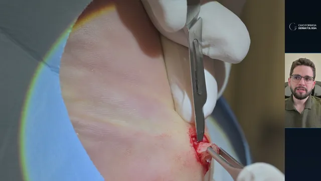 Poroma écrino plantar: diagnóstico diferencial, excisão em fuso e histopatologia