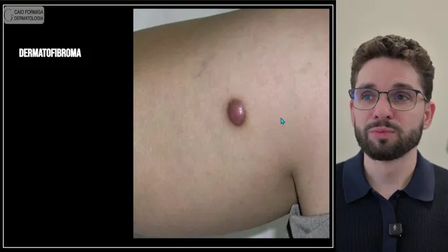Dermatofibroma