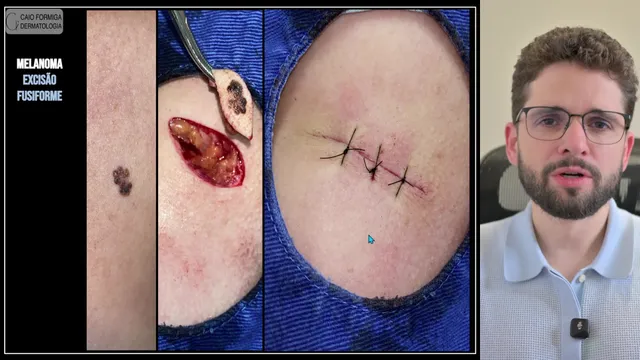 Melanoma: excisão fusiforme com margens mínimas