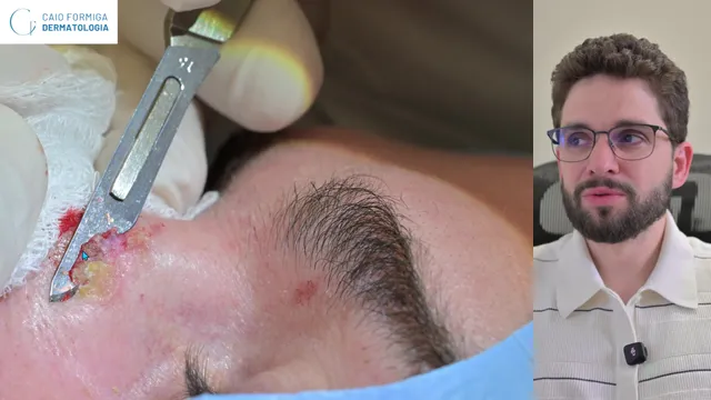 Doença de Bowen na face: diagnóstico, shaving, curetagem e conduta pós-histopatologia