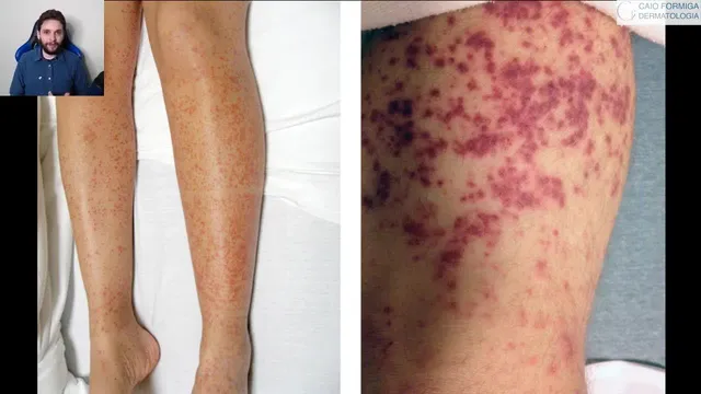 Vasculite cutânea de pequenos vasos