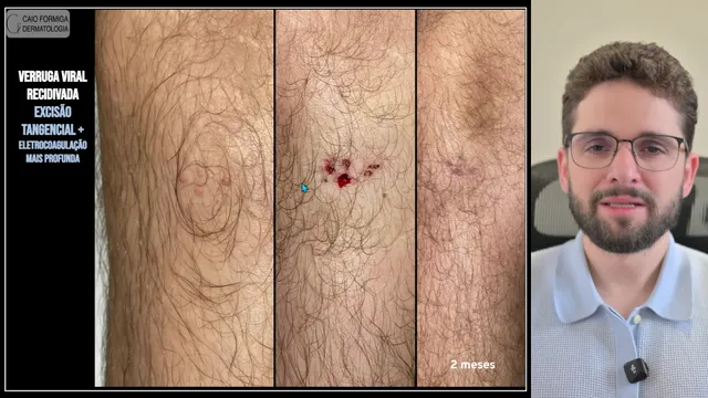 Verruga viral: excisão tangencial e eletrocoagulação
