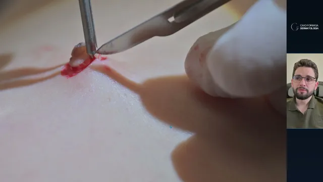 Nevo melanocítico intradérmico: quando fazer fuso e quando considerar shaving