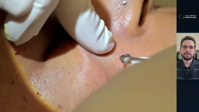 Dermatose papulosa nigra: curetagem segura em fototipos altos