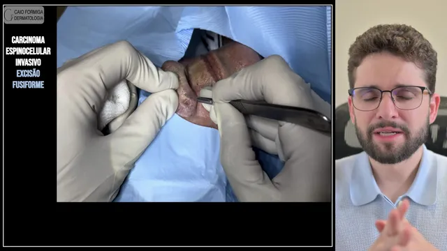 Carcinoma espinocelular invasivo: excisão fusiforme