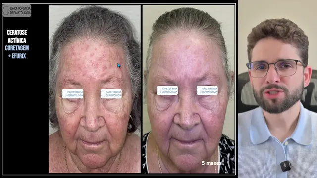 Ceratose actínica: excisão tangencial e eletrocoagulação
