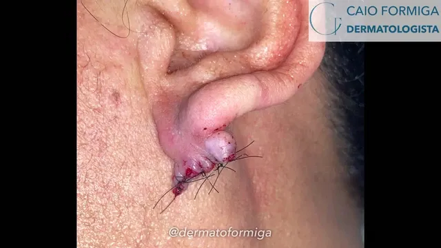 Queloide na orelha