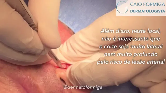 Carcinoma basocelular na asa do nariz