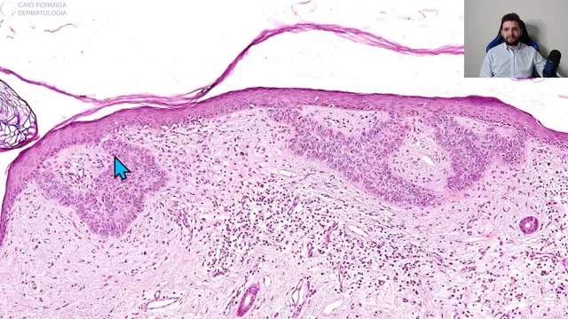 Carcinoma basocelular