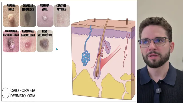 Proliferações da pele: o diagnóstico define a cirurgia
