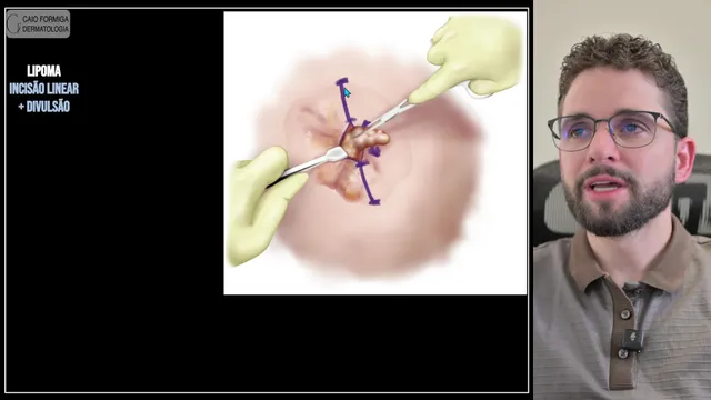 Lipoma: incisão linear e divulsão