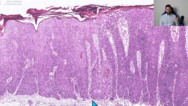 Carcinoma espinocelular