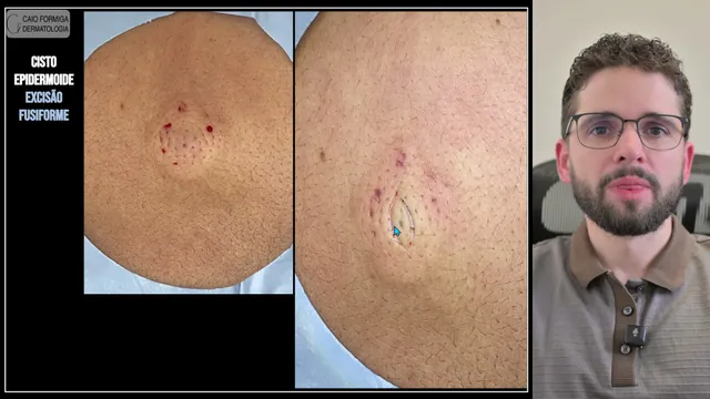 Cisto epidermoide: excisão fusiforme