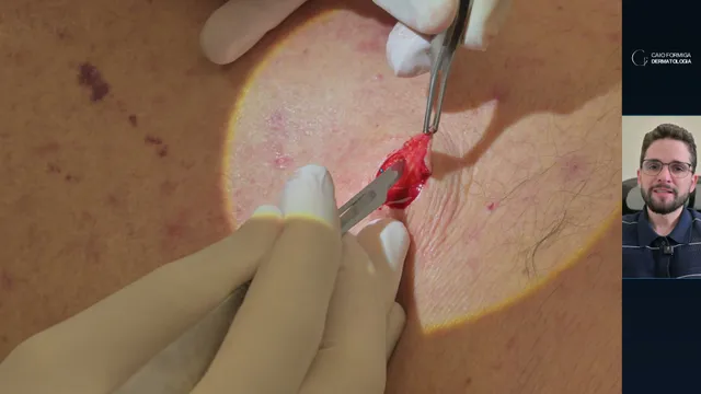 Carcinoma basocelular: remoção em bloco no plano do subcutâneo