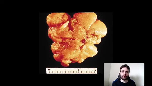 Lipoma