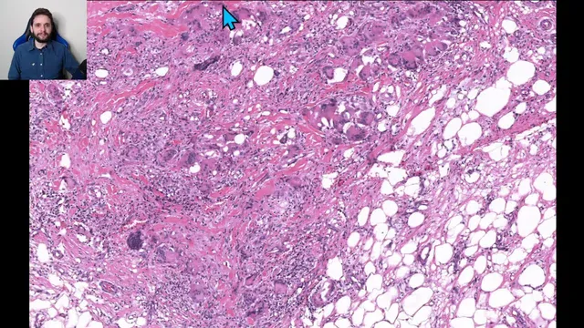 Paniculites