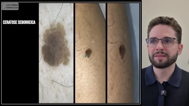 Ceratose seborreica