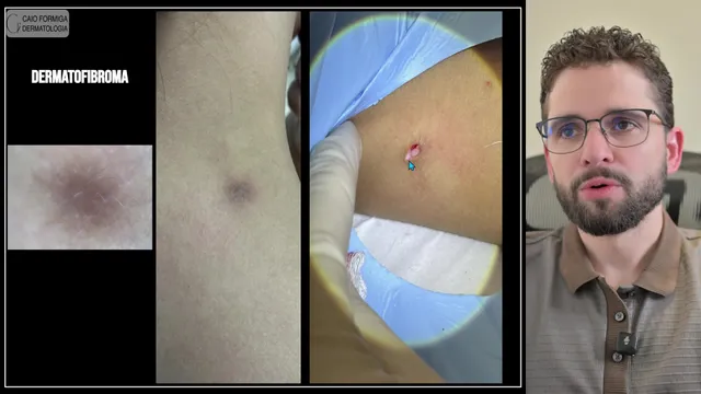 Dermatofibroma: excisão fusiforme