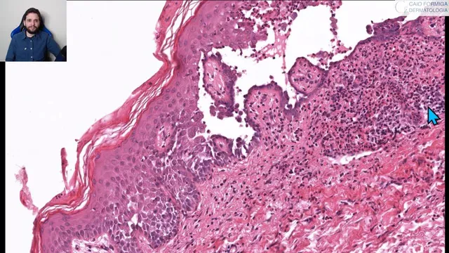 Dermatites vesicobolhosas