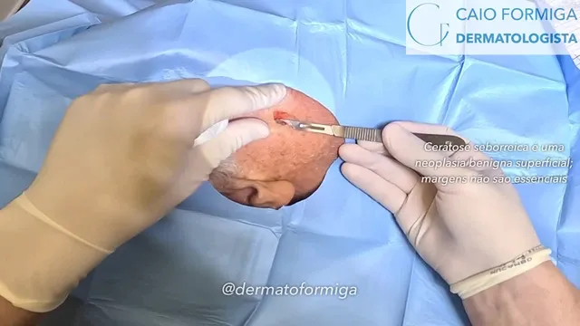 Ceratose seborreica: excisão tangencial.