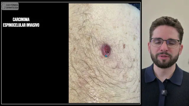 Carcinoma espinocelular