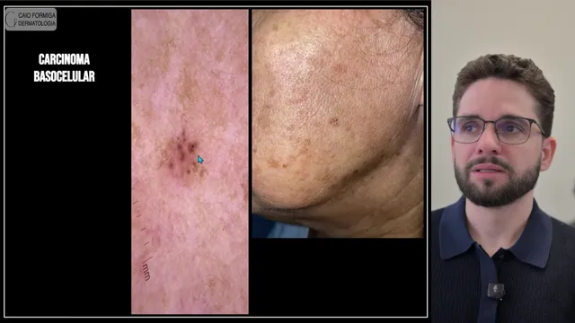 Carcinoma basocelular