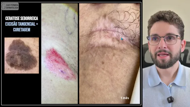 Ceratose seborreica: curetagem e excisão tangencial