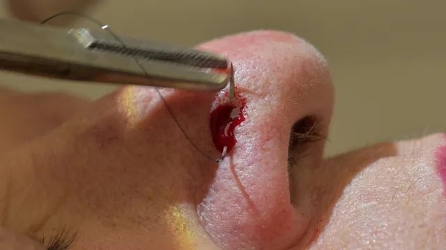 Carcinoma basocelular: biópsia incisional punch