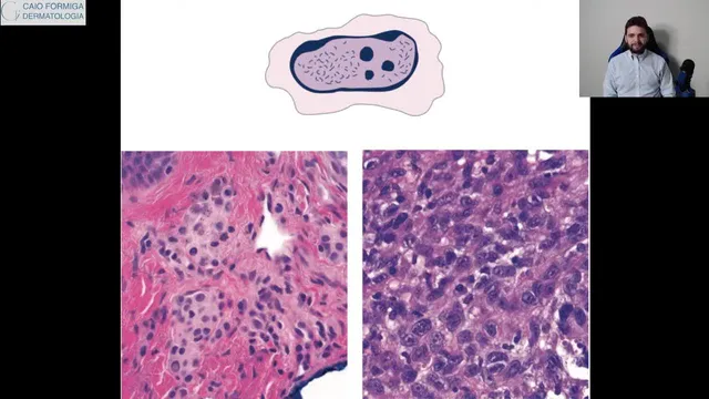 Neoplasias dermatológicas