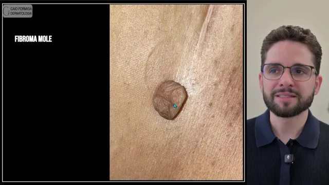 Fibroma mole
